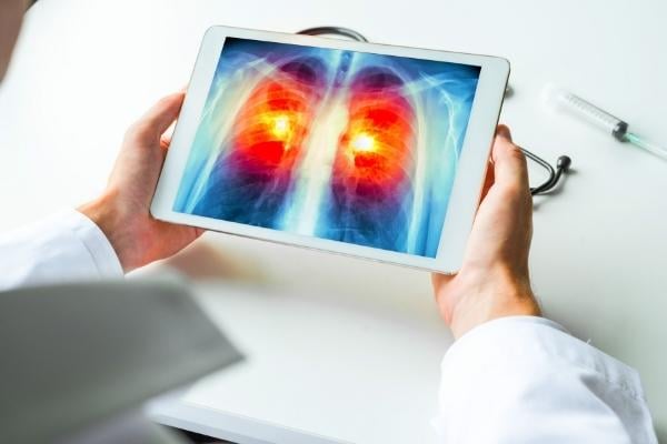 Lung cancer is a symptom of radon exposure